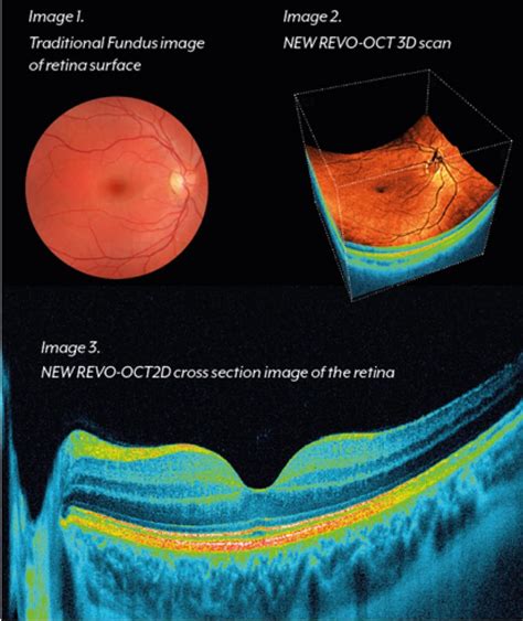 my oct test for thickness was 0.78|does oct detect retinal fluid.